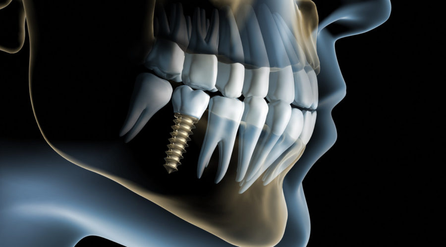 Boost your smile, with Dental Implants – starting at 300€